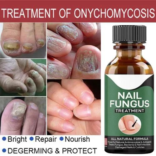 Fast Nail Fungal Treatment Serum – Nail Repair Essence for Damaged Toenails & Fingernails