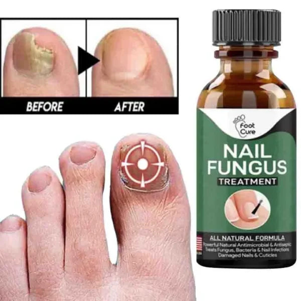 Fast Nail Fungal Treatment Serum – Nail Repair Essence for Damaged Toenails & Fingernails